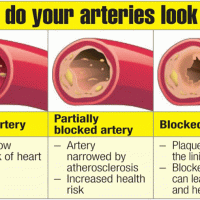 3 Simple Rules Will Help You Unclog Your Arteries Naturally