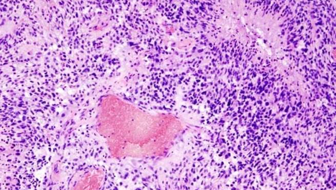 Understanding glioblastoma, the most common—and lethal—form of brain cancer